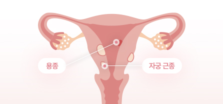 비정상 자궁출혈의 원인 이미지
